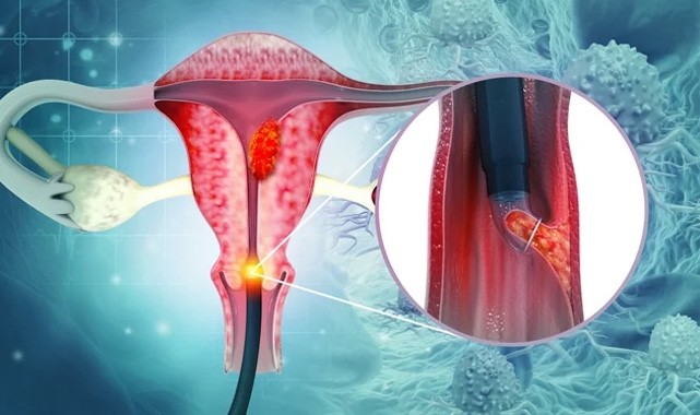 Rahim ağzı kanserine karşı tarama çağrısı