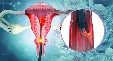 Rahim ağzı kanserine karşı tarama çağrısı